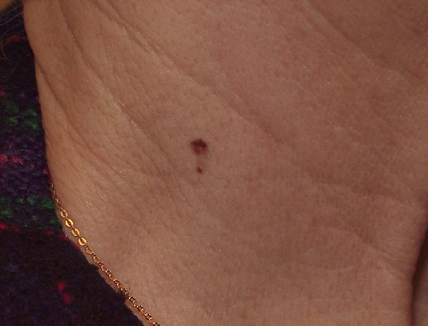 pictures of melanoma on leg