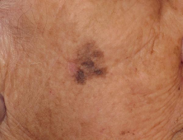 Melanoma Image 6B - Medium