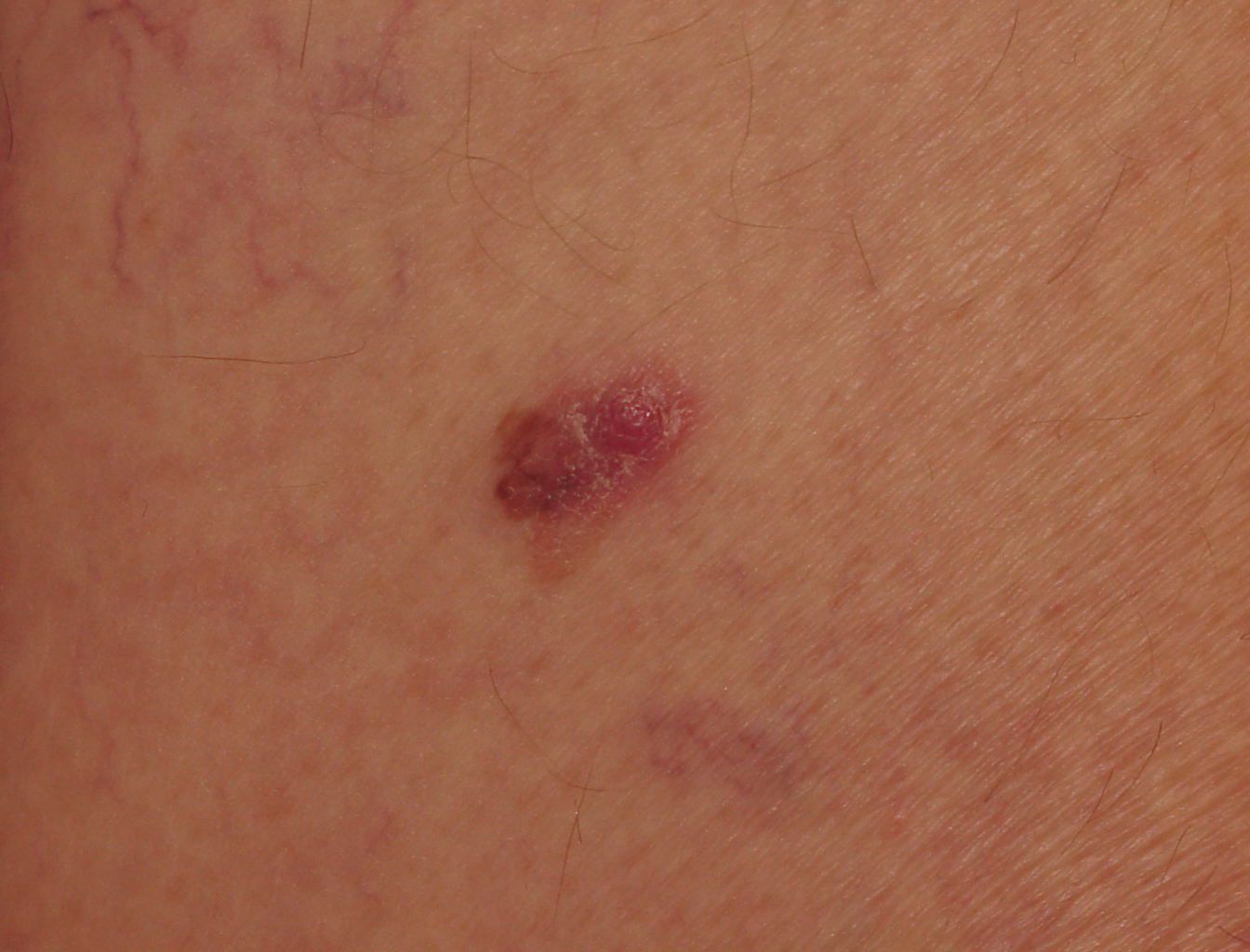 Melanoma Image 8B - Large