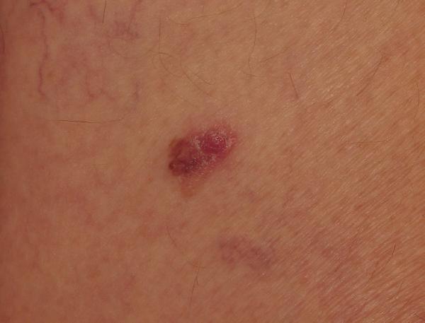 Nodular Melanoma Pictures Early Pictures Photos