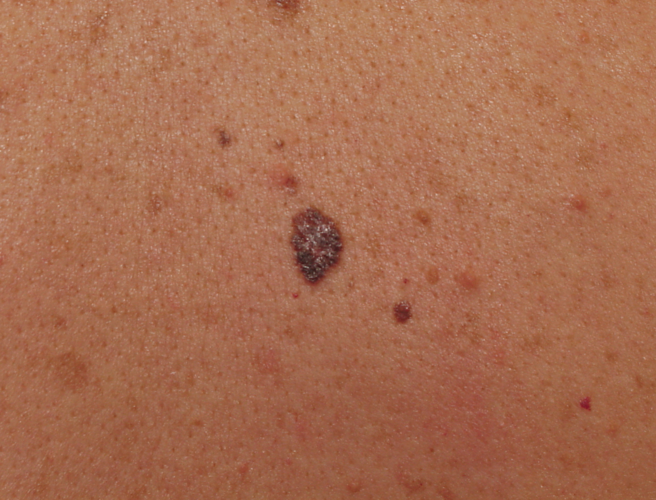 moles on skin