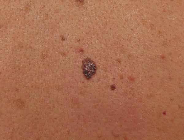 Melanoma Image 9B - Medium