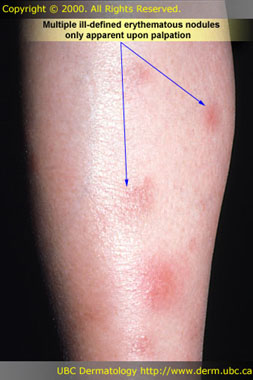 Nodule