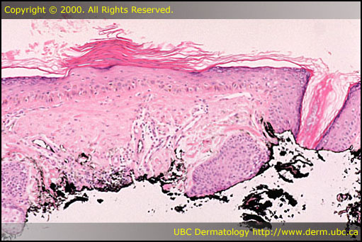 Actinic keratosis