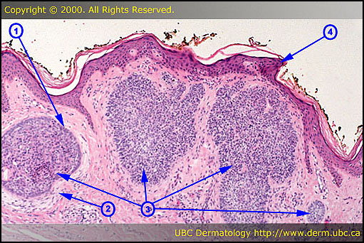 Basal cell carcinoma