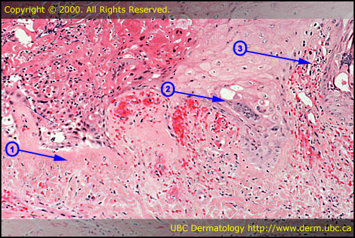 Herpes simplex