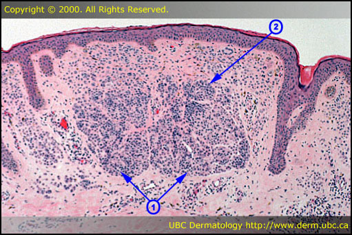 Melanocytic nevus