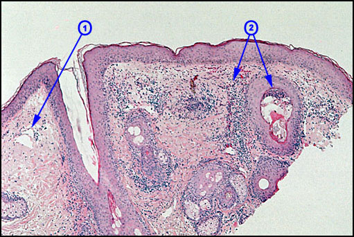 Rosacea