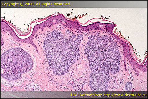 Basal cell carcinoma