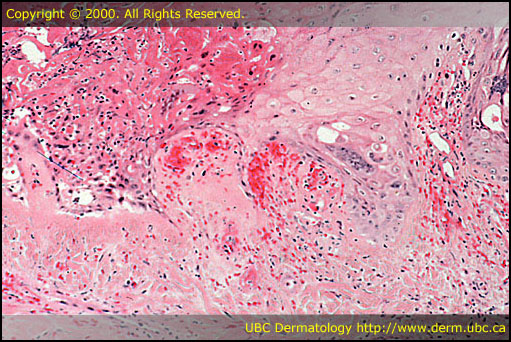 Herpes simplex