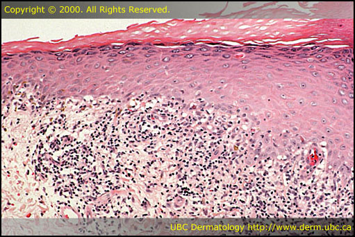 Lichen planus