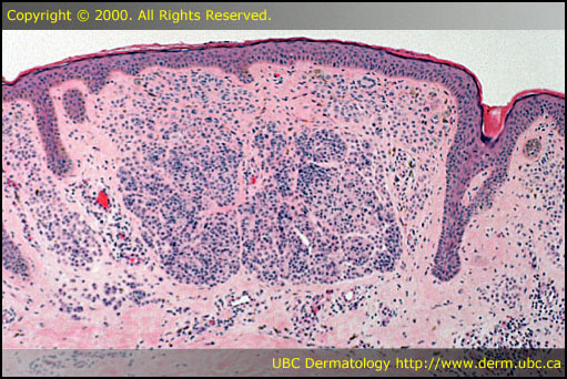 Melanocytic nevus