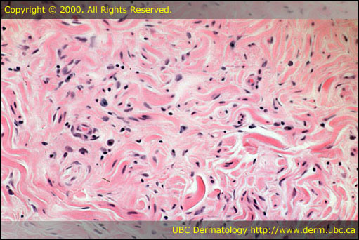 Neurofibroma