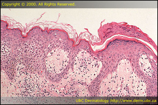 Pityriasis rosea