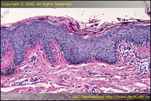 Pityriasis versicolor