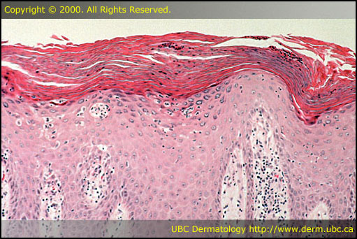 Psoriasis