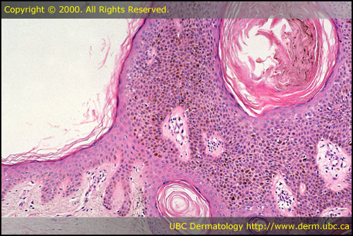 Seborrheic keratosis