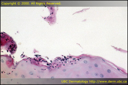Tinea corporis