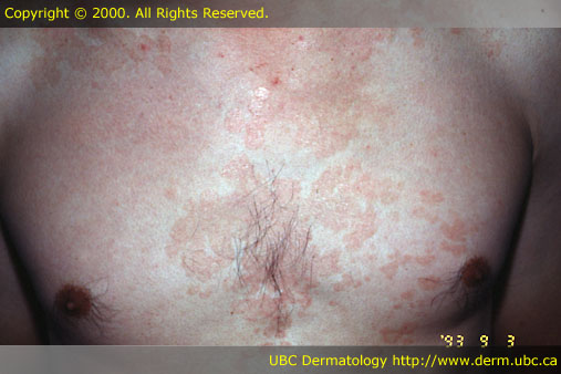 Pityriasis Versicolor