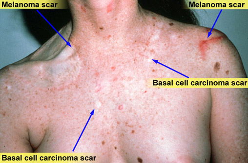 skin cancer image