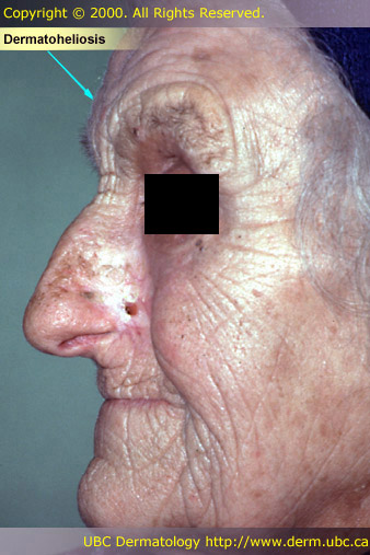 Dermatoheliosis