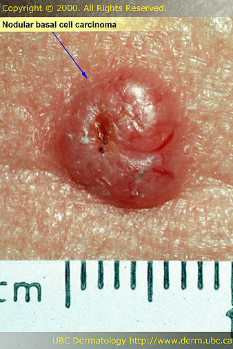 Basal Cell Carcinoma: Advanced Nodular BCC ... - MedicineNet