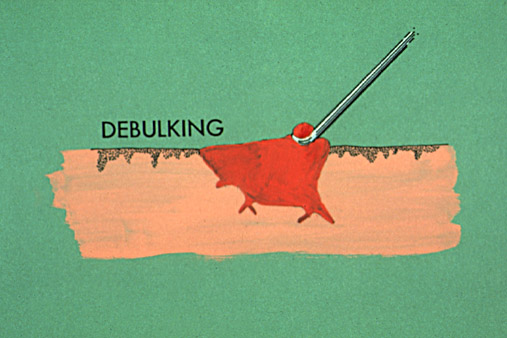 Debulking