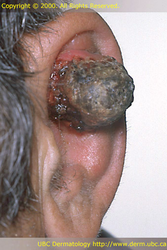 Skin most cancers