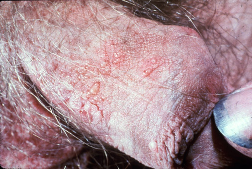 Penis and scrotum - Herpes simplex virus (HSV)