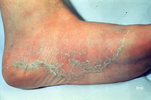 Superficial Fungal Infections | Online-Only Article ...